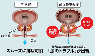 前立腺肥大症の原因