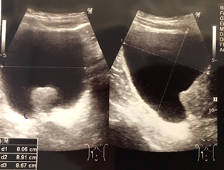 前立腺肥大症の検査