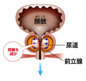 前立腺肥大症の治療