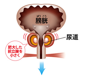 前立腺肥大症の治療
